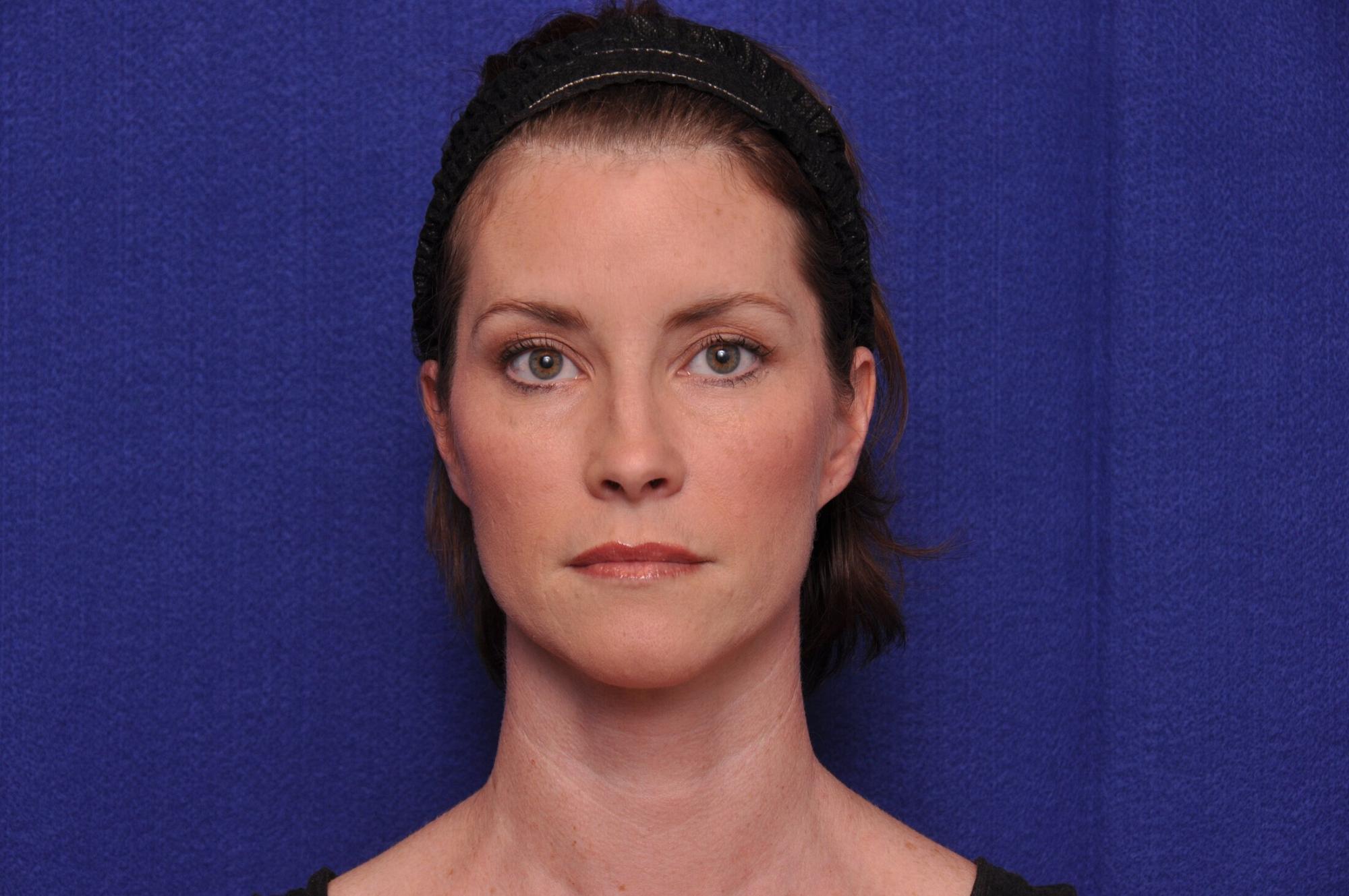 After photo of Vero Beach patient's torso