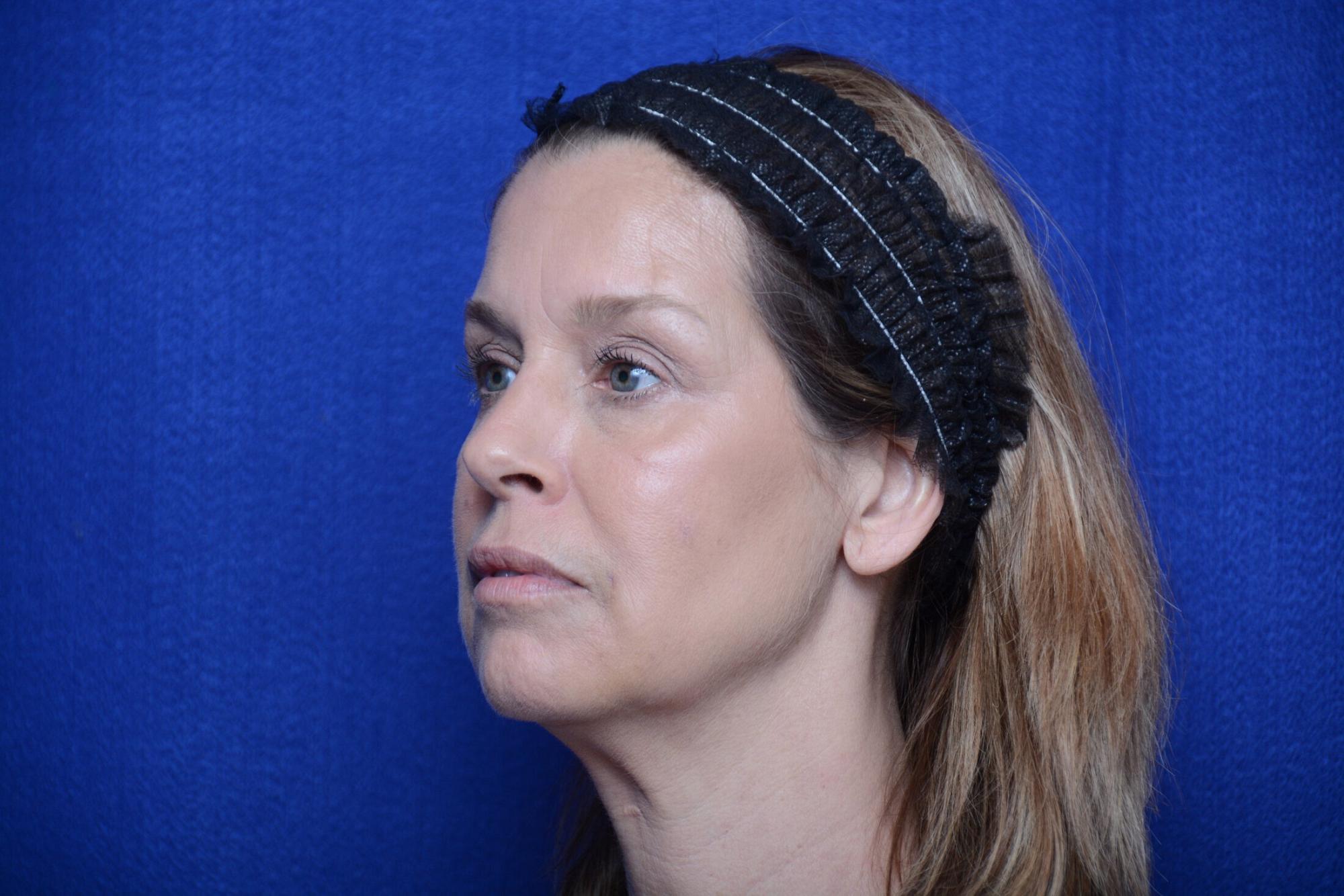 After photo of Vero Beach patient's torso
