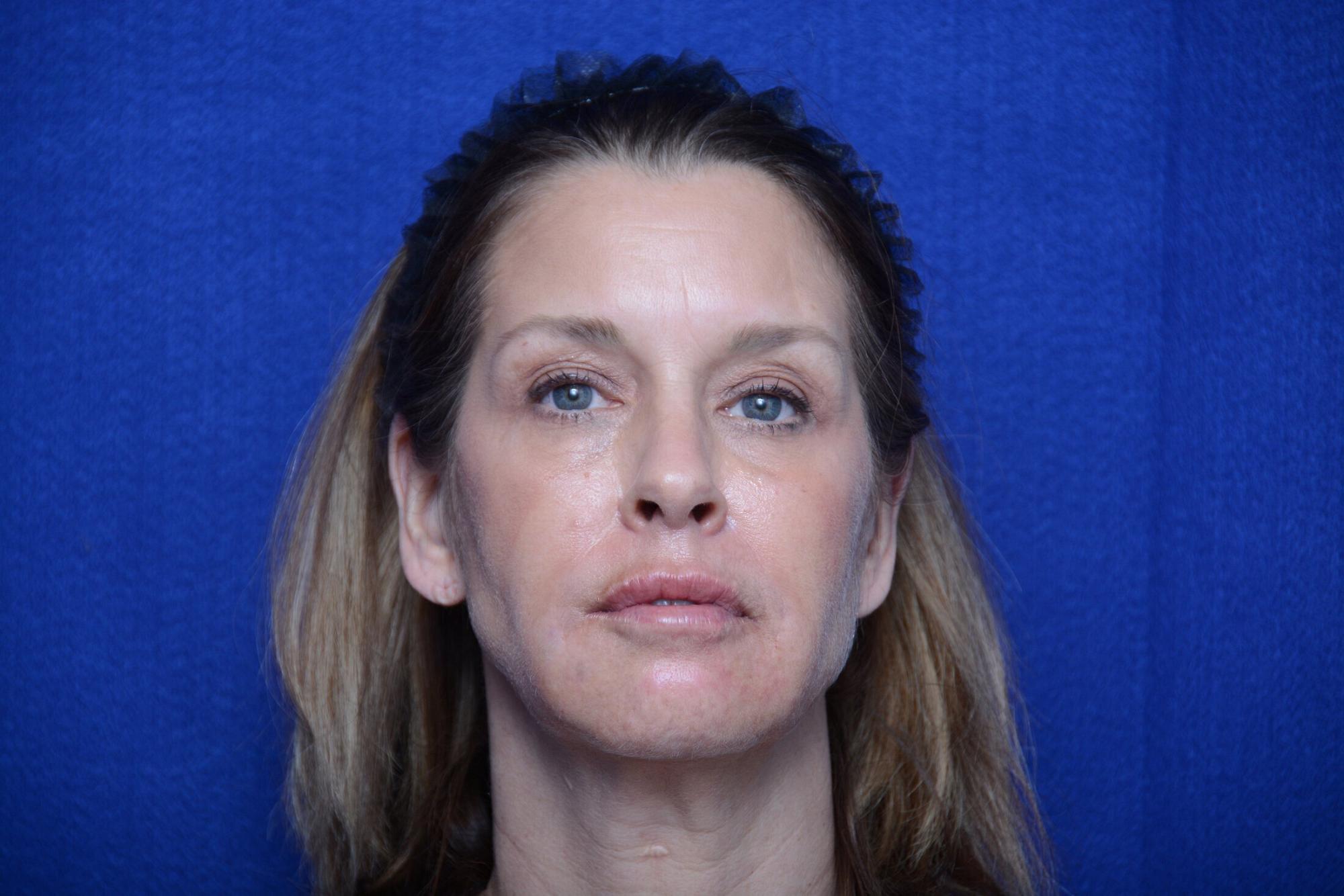 After photo of Vero Beach patient's torso
