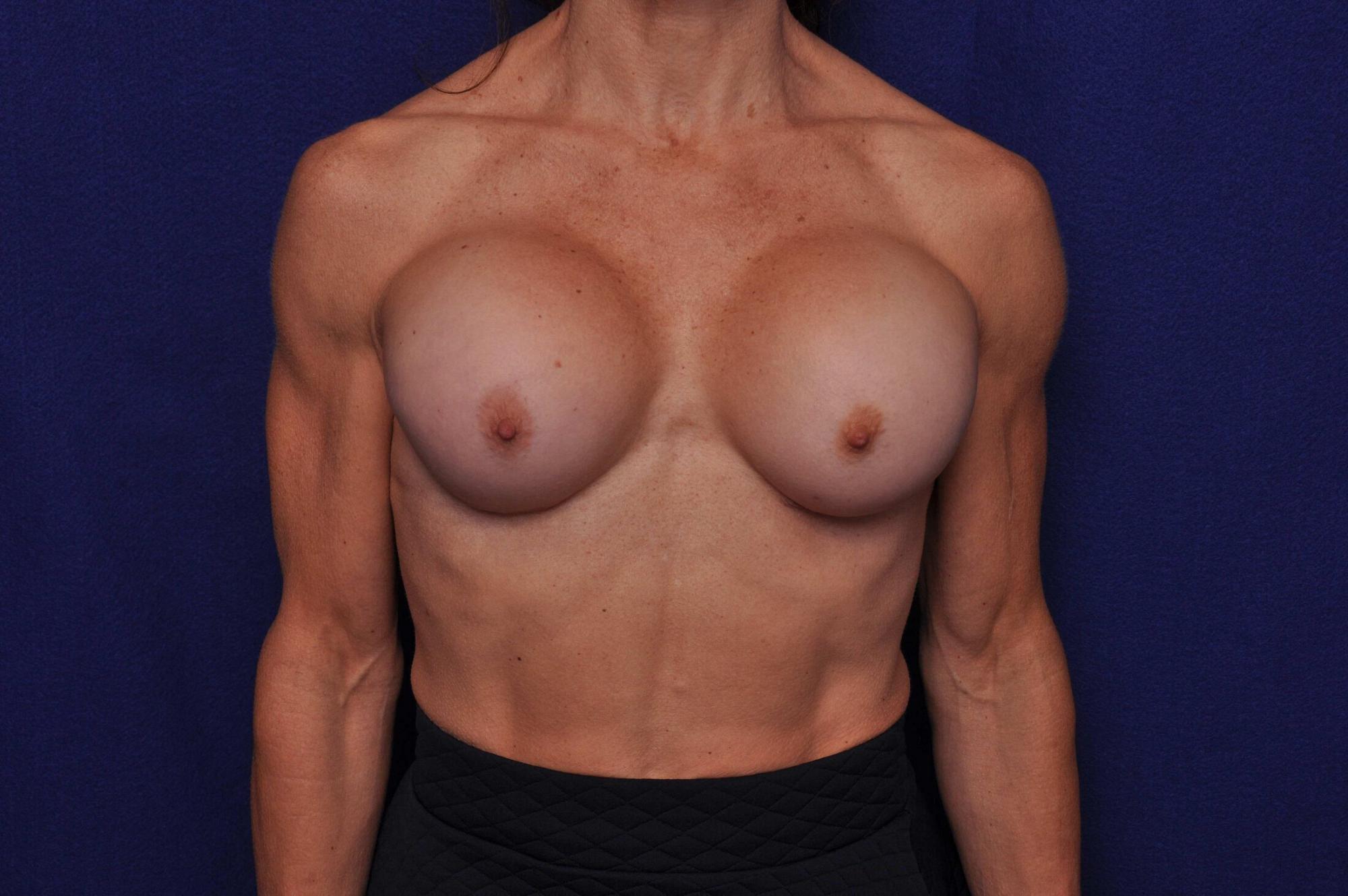 After photo of Vero Beach patient's torso