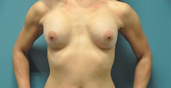 After photo of Vero Beach patient's torso