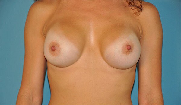 After photo of Vero Beach patient's torso