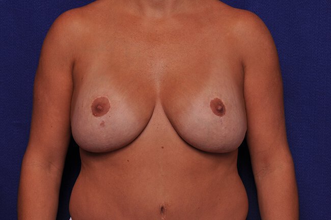 After photo of Vero Beach patient's torso