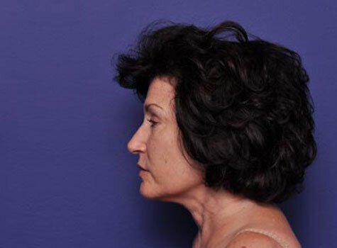 Before photo of Vero Beach patient's torso