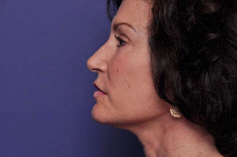 After photo of Vero Beach patient's torso
