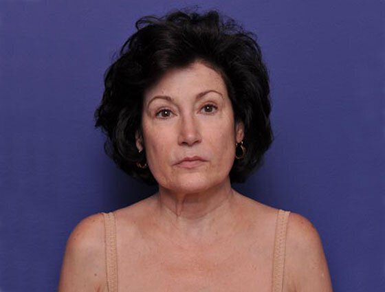 After photo of Vero Beach patient's torso