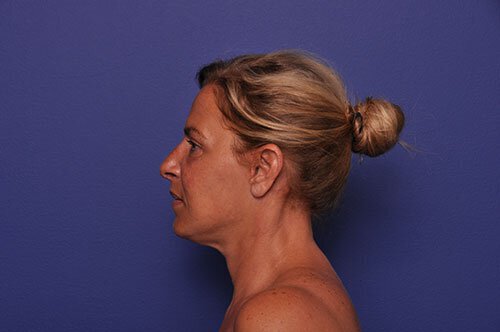 After photo of Vero Beach patient's torso