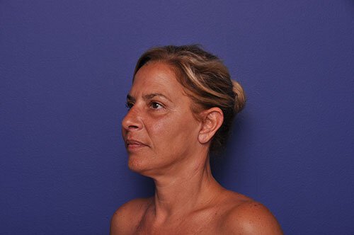 After photo of Vero Beach patient's torso