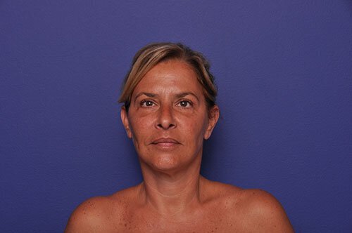 After photo of Vero Beach patient's torso