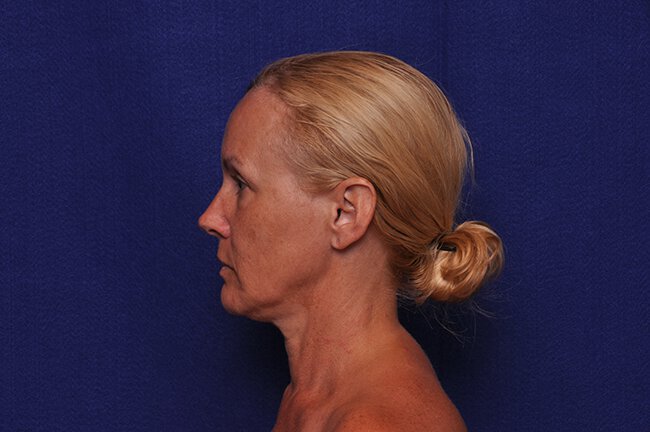 Before photo of Vero Beach patient's torso