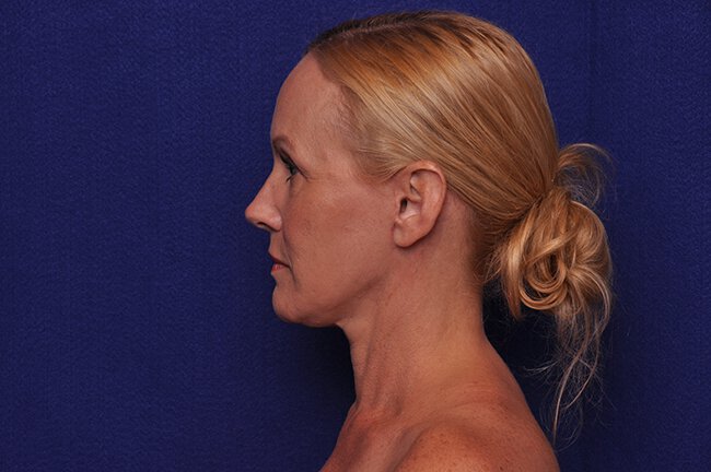 After photo of Vero Beach patient's torso
