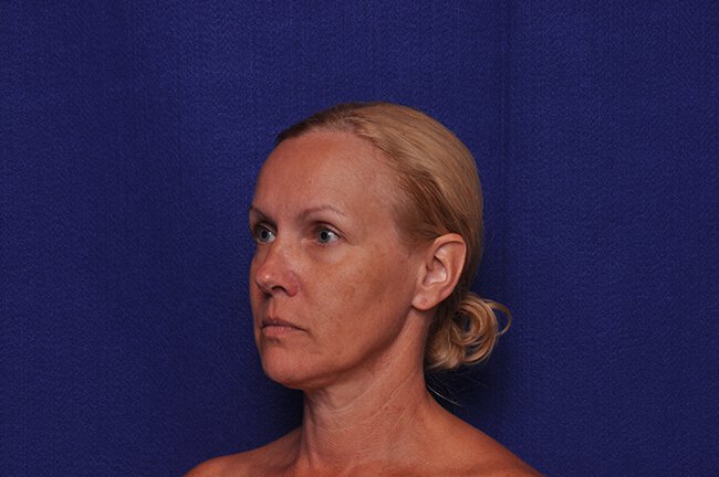 After photo of Vero Beach patient's torso
