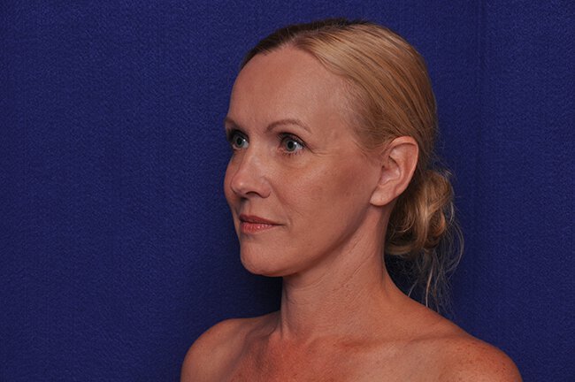 After photo of Vero Beach patient's torso