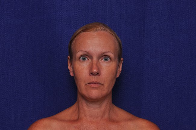 After photo of Vero Beach patient's torso
