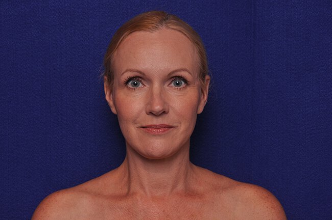 After photo of Vero Beach patient's torso
