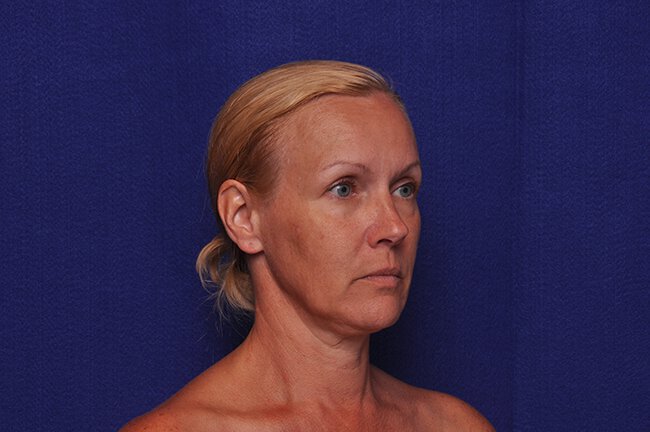 After photo of Vero Beach patient's torso