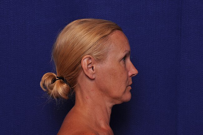 After photo of Vero Beach patient's torso