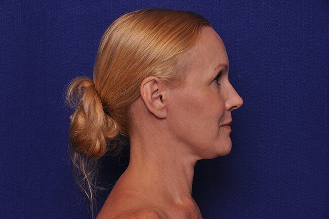 After photo of Vero Beach patient's torso