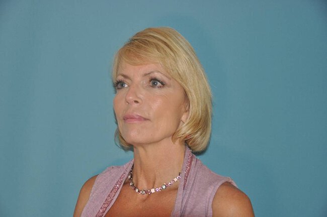 Before photo of Vero Beach patient's torso