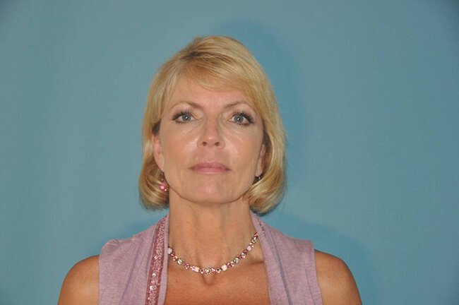After photo of Vero Beach patient's torso