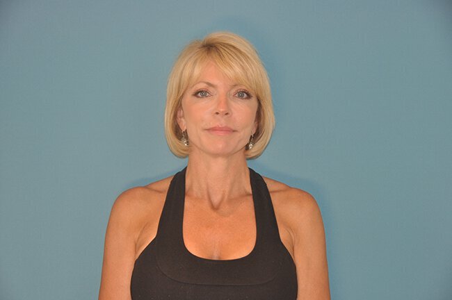 After photo of Vero Beach patient's torso