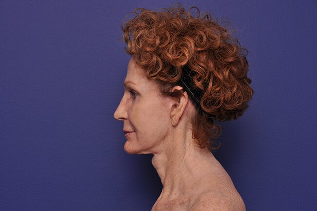 Before photo of Vero Beach patient's torso