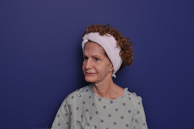 After photo of Vero Beach patient's torso