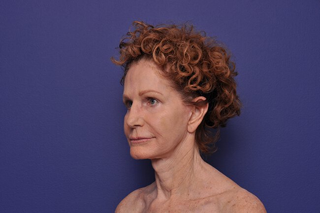 After photo of Vero Beach patient's torso