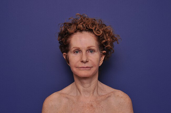After photo of Vero Beach patient's torso