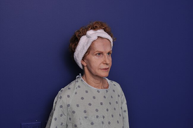 After photo of Vero Beach patient's torso