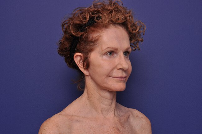 After photo of Vero Beach patient's torso