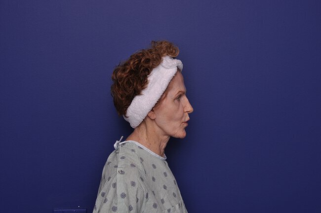 After photo of Vero Beach patient's torso
