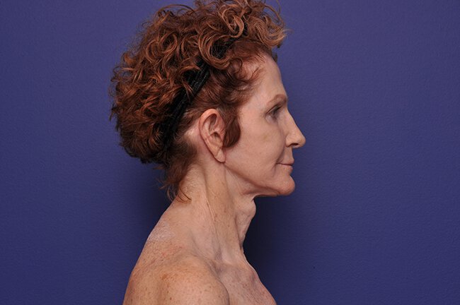 After photo of Vero Beach patient's torso