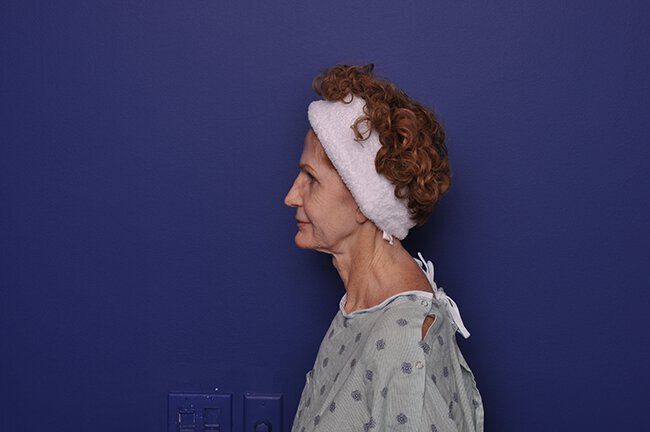 After photo of Vero Beach patient's torso