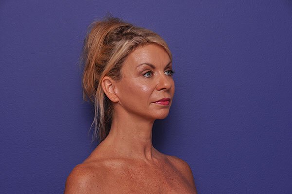 After photo of Vero Beach patient's torso