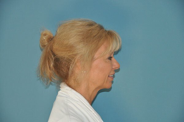 After photo of Vero Beach patient's torso