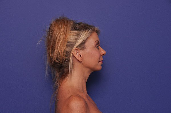 After photo of Vero Beach patient's torso
