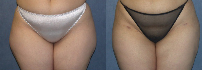 awake liposuction before and after