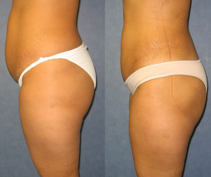 360 liposuction before and after