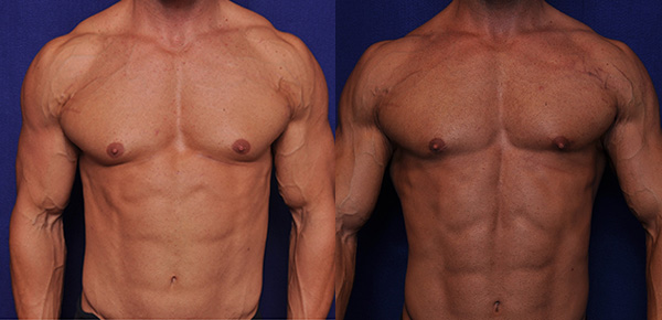 high definition liposuction before and after
