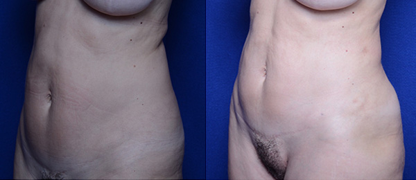 hi def liposuction before and after
