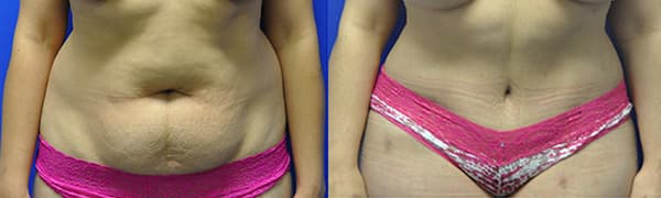 large volume liposuction before and after