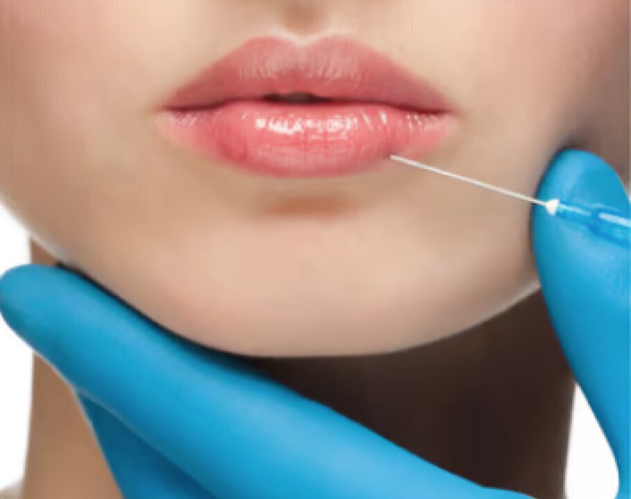 Vero Beach Dermal fillers patient model receiving injectable filler