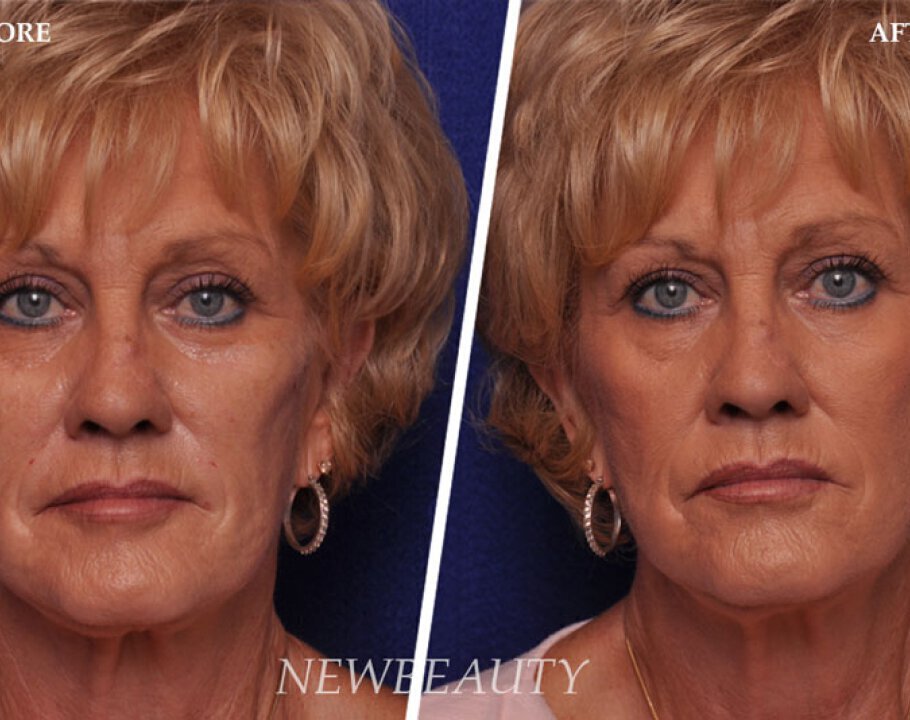 Woman before and after dermal fillers