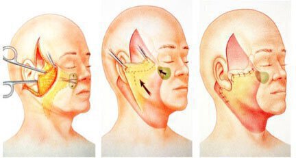 Vero Beach Face lift procedure diagram