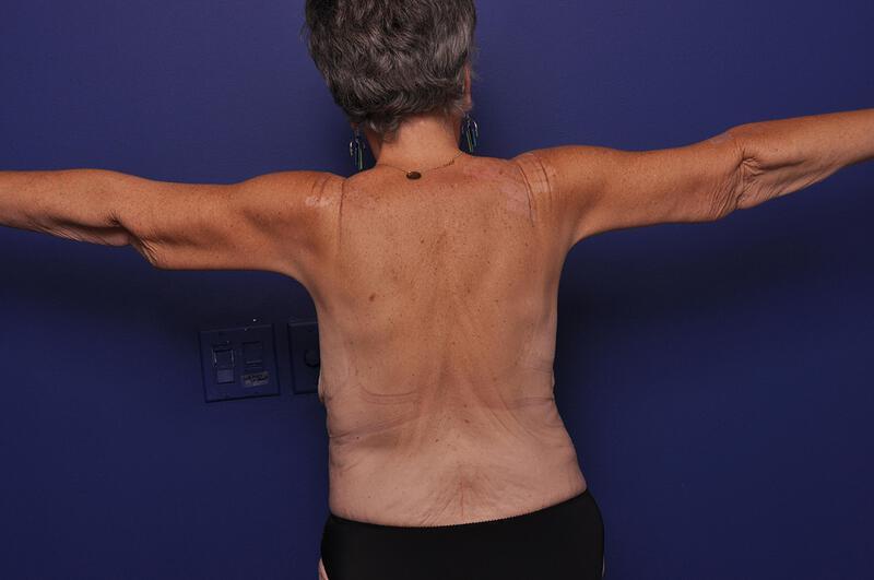 Arm Lift Gallery Before & After Image