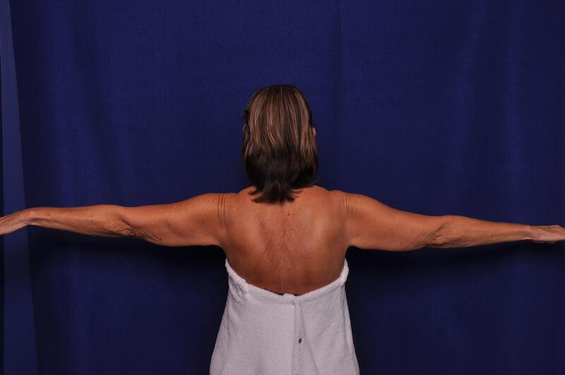 Arm Lift Gallery Before & After Image