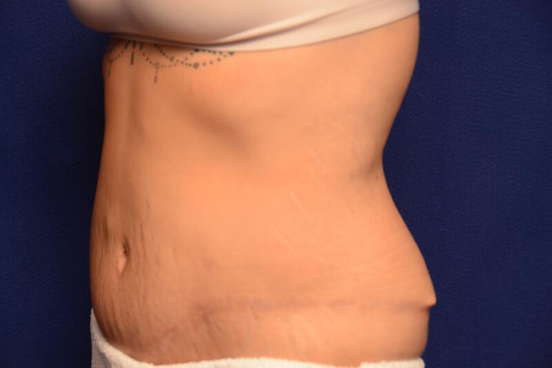 Body Lift Gallery Before & After Image