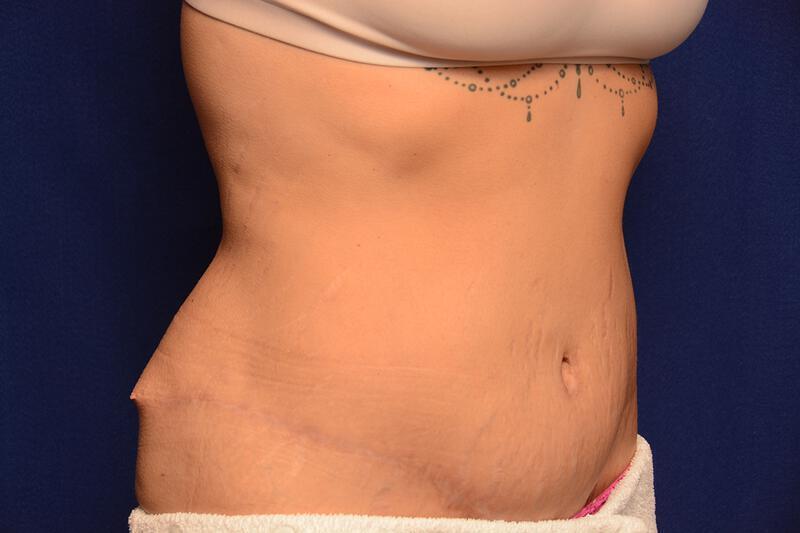 Body Lift Gallery Before & After Image