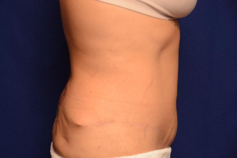 Body Lift Gallery Before & After Image